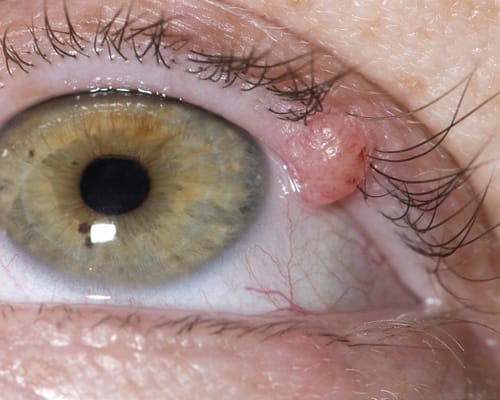 Tumor maligno das pálpebras: principais características e sintomas