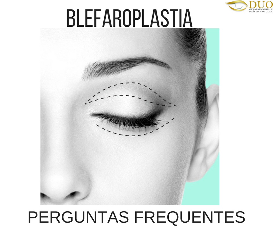 6 perguntas frequentes sobre a blefaroplastia