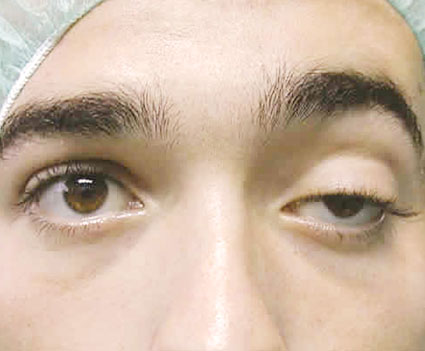 Saiba como funciona a cirurgia de ptose palpebral