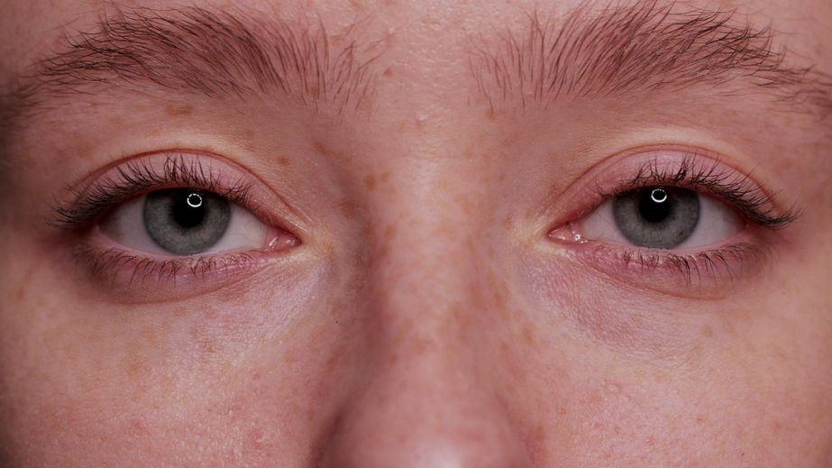 5 sinais que você pode estar com queda da pálpebra