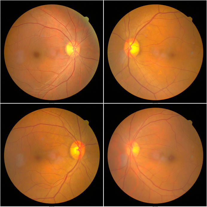 Retinopatia diabética