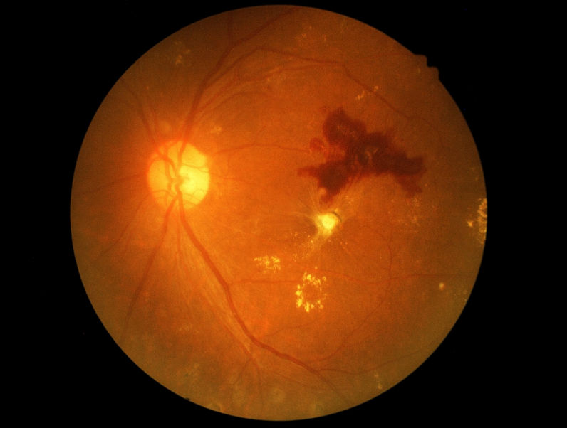 Retinopatia diabética: sintomas e causas