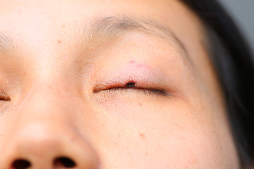 Melanoma palpebral: o que é e quais os tratamentos?