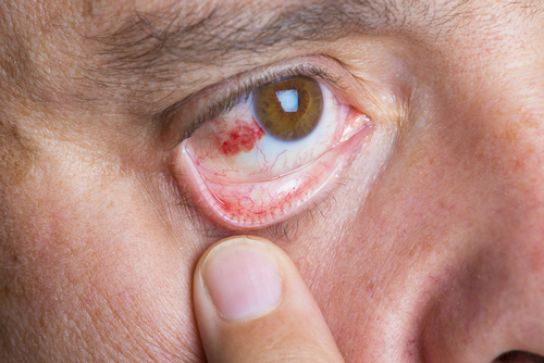 Retinopatia diabética: conheça as causas e sintomas