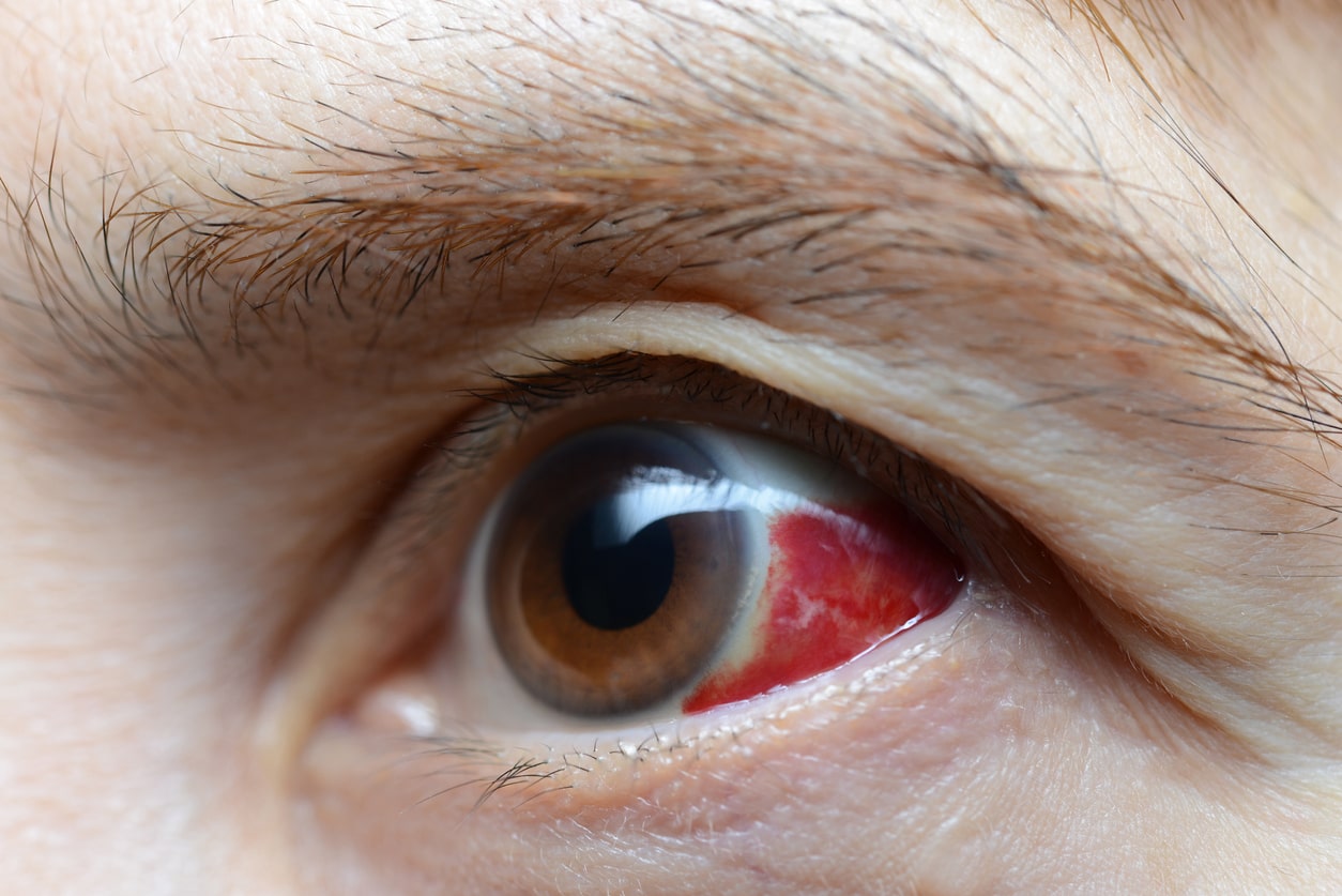 Derrame Ocular: Por Que Ocorre E Como Tratar?
